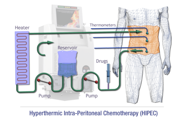 Hyperthermic intraperitoneal chemotherapy