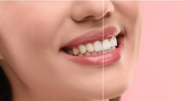 What are the main causes of tooth discolouration?