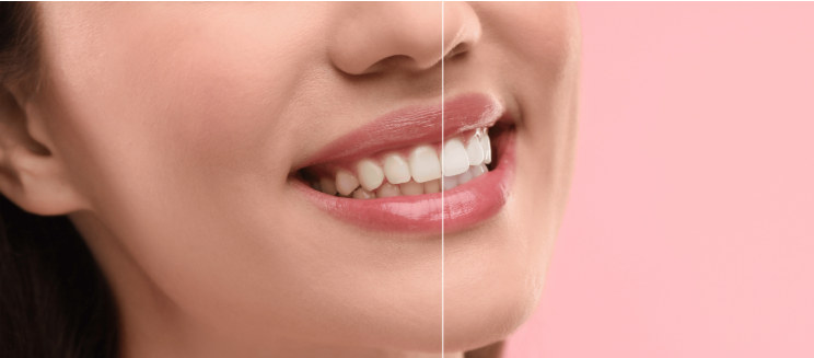 What are the main causes of tooth discolouration?