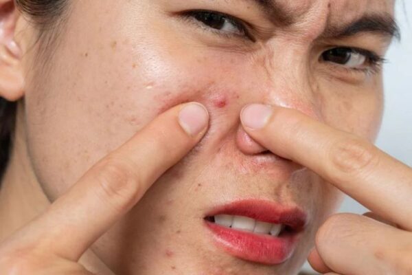 Tips to Control Excess Oil and Prevent Breakouts During Rainy Season Excess Oil